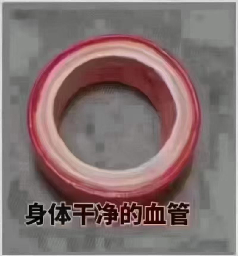 对对您的血管
血管堵了怎么办？ ——堵在心脏叫梗，堵在毛细血管叫瘤， 堵在肝脏叫肿瘤，堵在子宫叫肌瘤