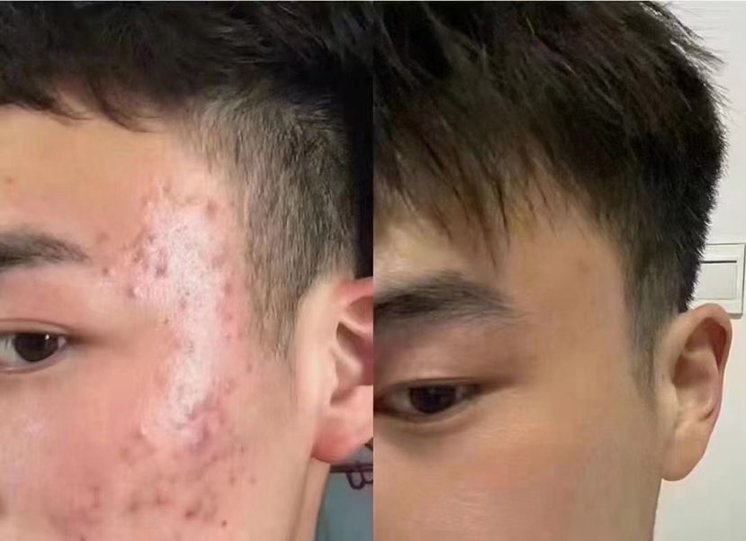 暑假了，有痘赶紧治，开学了别影响心情和颜值👏