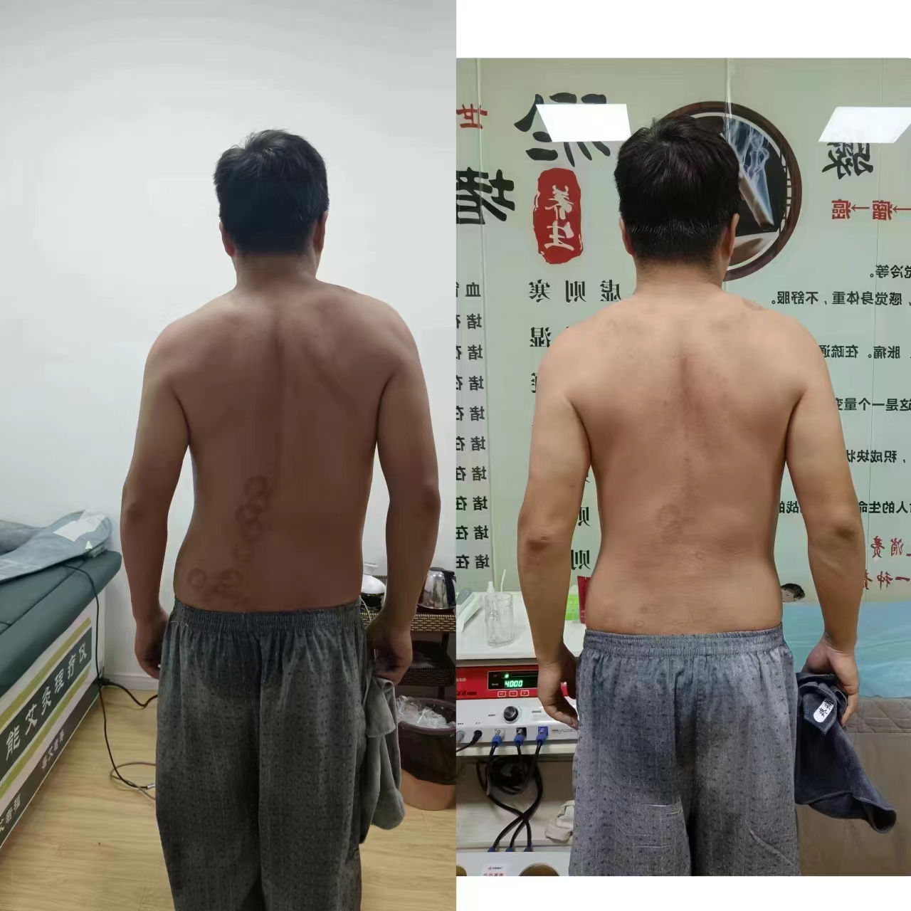开背，走罐，定罐+全身温通