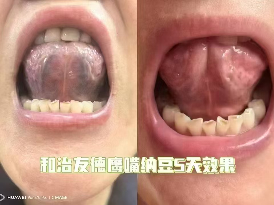 【和治友德​鹰嘴纳豆5⃣️天的效果】⬇️⬇️⬇️
[爱心]鹰嘴纳豆是一款“人类瑰宝”级的发酵性豆制品