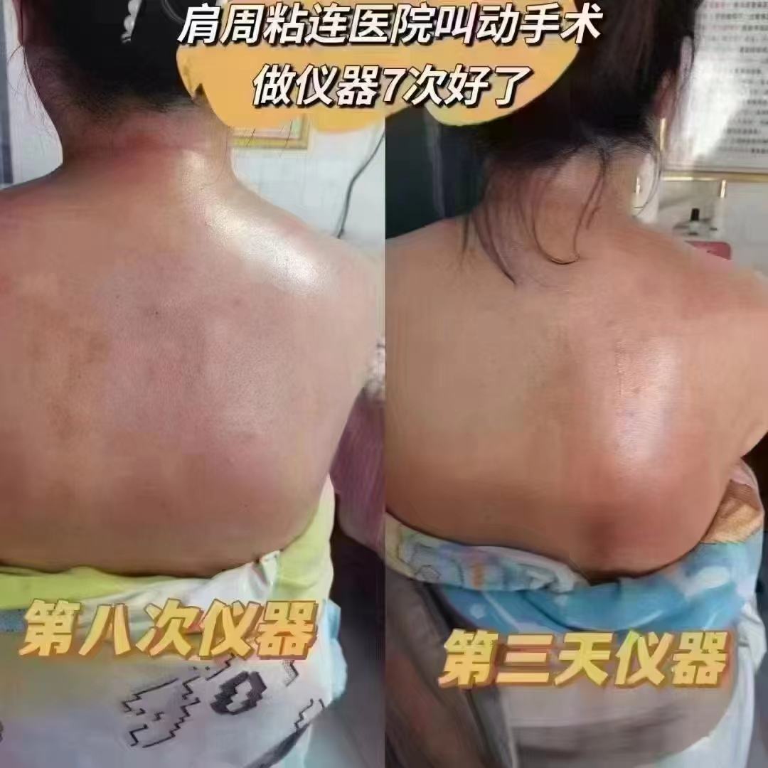 美女肩周粘连，中医院叫做手术，听朋友推荐做仪器，抱着试试看的心态，七次就好了，美女自己说没想到效果这