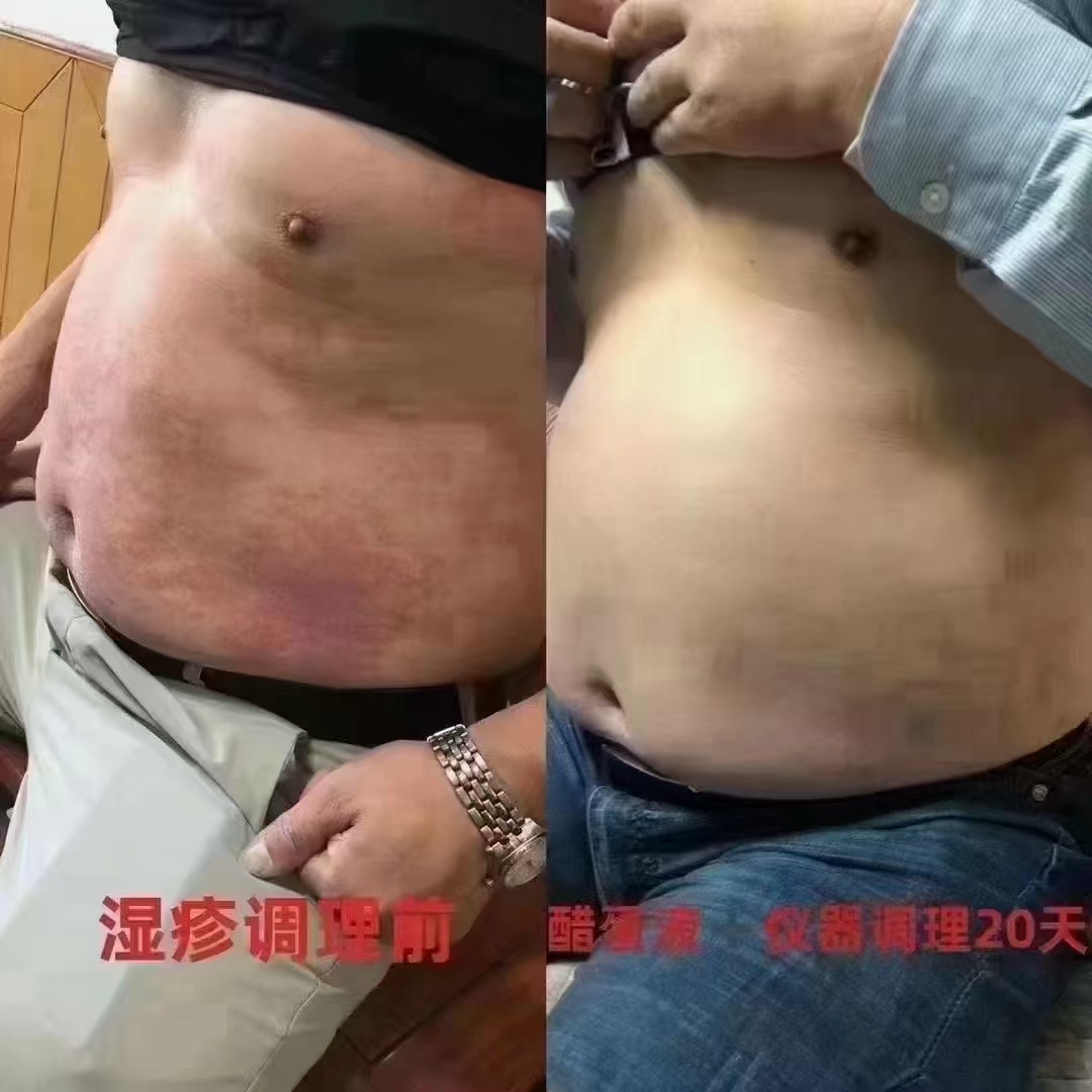 分享案例[玫瑰][玫瑰][玫瑰]
这位顾客全身湿疹厉害，破口难于愈合伤口，皮肤一直冒出水，用了很多方