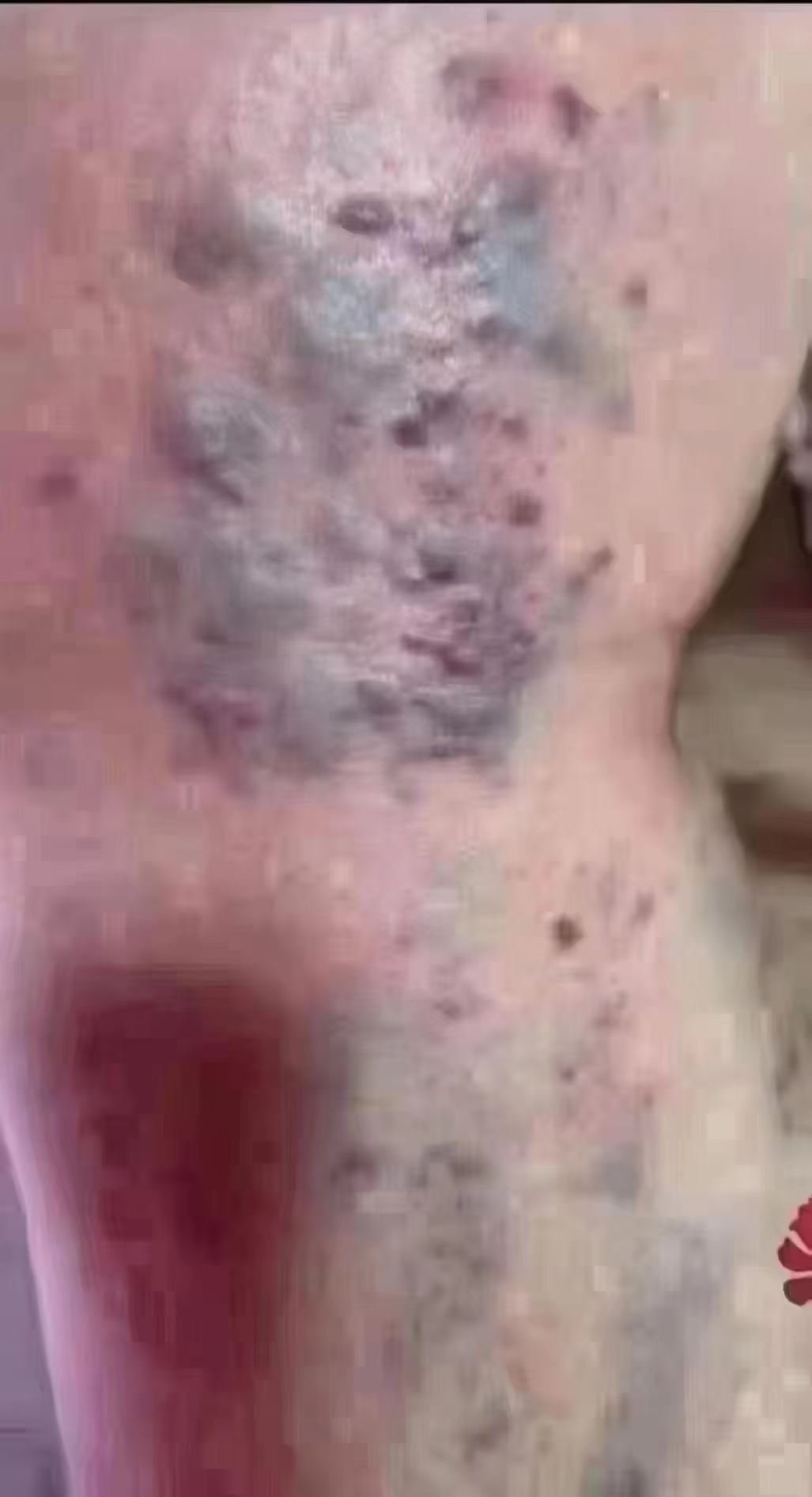 痧出=病出 
  黑疙瘩＝血栓
中医有句话叫，血栓淤堵  瘀血不去，新血不生
出痧：把瘀阻的血刮出来
