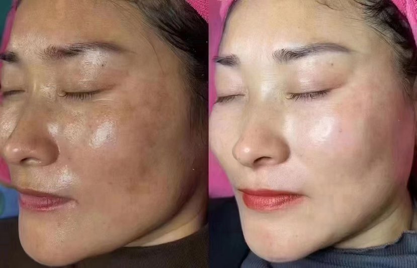 如果你没有天生的好皮肤，后期只要用用我的套盒，改善天生黑、黄、斑斑点点-能让你变白变美有光泽🌹